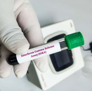 Blood sample for Interferon Gamma Release Assay (IGRA) test for diagnosis of Tuberculosis.
