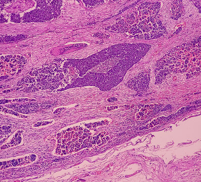 Metastatic olfactory neuroblastoma or esthesioneuroblastoma. Microscopically show reactive change.