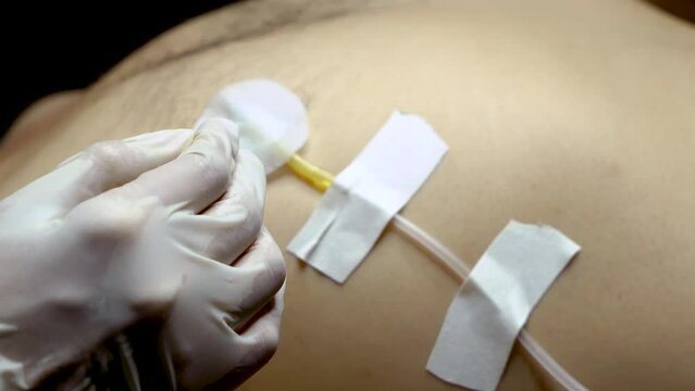 4K, Close-up figure patient lying on top cloth, doctor's tools are attached flesh patients undergoing surgery, It is tool that doctors need stick support the patient's life.