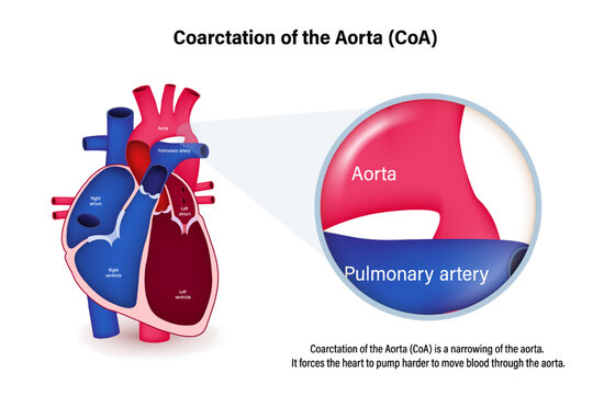 Coarctation of the Aorta vector. Congenital heart disease. 