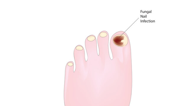 fungal nail infections, fungal nail infection, eczema, dermatitis, inflammation, nail plate, onychogryphosis, illustration, unhealthy, healthy, human, hygiene, problem, sick, feet, toes, psoriasis, de