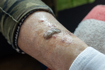 Ulcers and skin diseases, dried scabs and fresh wounds on the legs of an elderly woman, Health concept, senile changes - obrazy, fototapety, plakaty