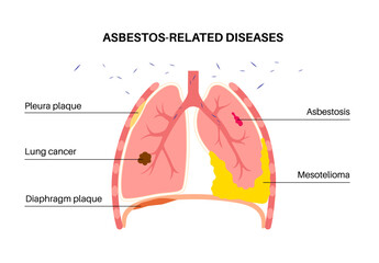 Asbestos related diseases