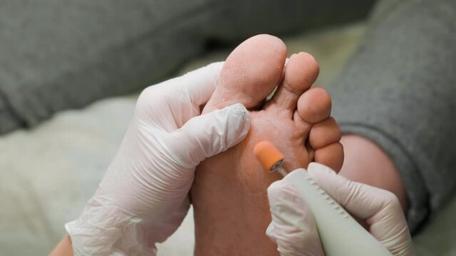 Removal of a rough keratinized layer from the skin of the foot using the grinding tool. Podology and pedicure