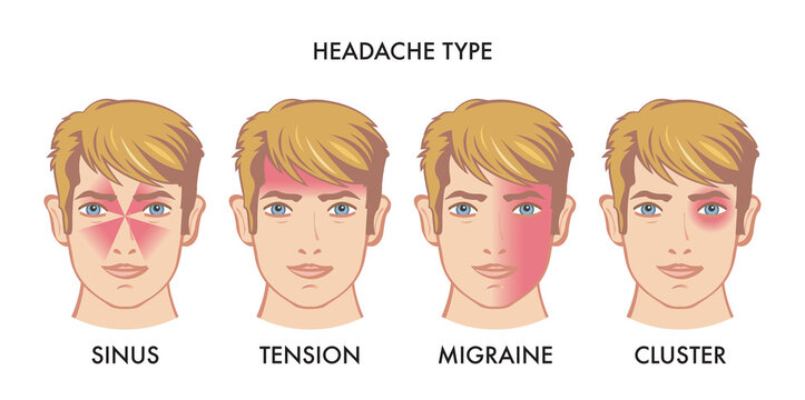 Illustration of types of headache