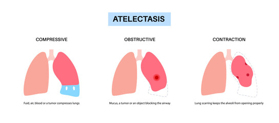 Atelectasis medical poster