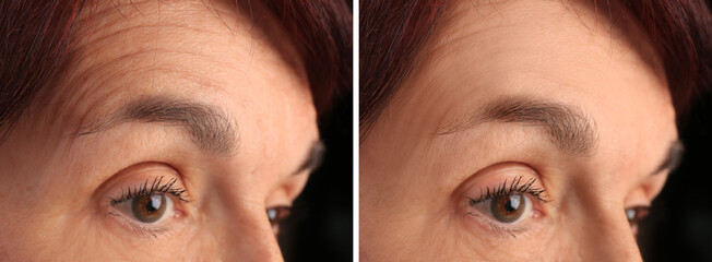 Mature woman before and after skin tightening treatments. Collage with photos on black background,...