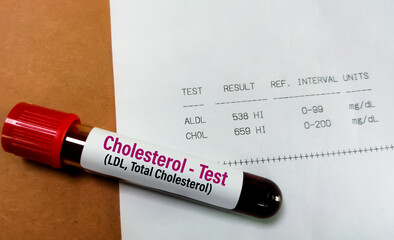 Blood sample with abnormal high report of Total Cholesterol and LDL cholesterol test.