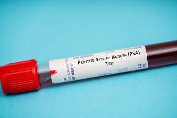 Prostate-Specific Antigen (PSA) Test - 595580834