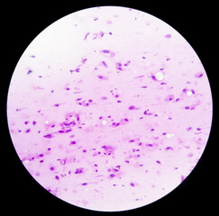 Photomicrograph showing Neurofibroma. Neurofibromatosis, is a genetic disorder (mutations).