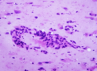 Photomicrograph showing Neurofibroma. Neurofibromatosis, is a genetic disorder (mutations). - obrazy, fototapety, plakaty