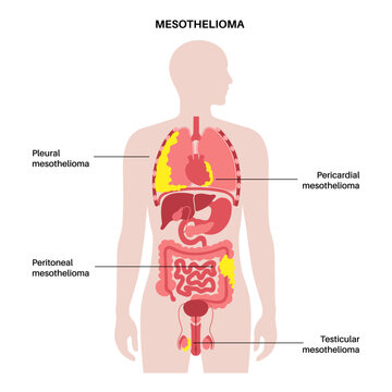 Mesothelioma tumor types