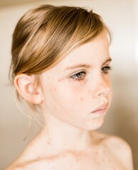 Chickenpox, varicella virus or vesicular rash on little girl body and face. Close-up Portrait of Kid with red pimples