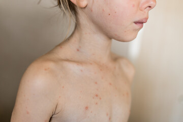 Obscured face of Little girl with Chickenpox, varicella virus or vesicular rash, Close-up