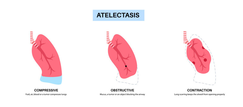 Atelectasis medical poster