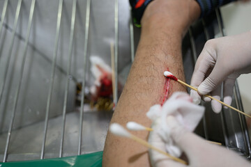 Nurses are treating a bleeding wound on the leg caused by an accident