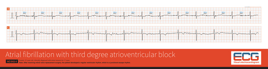 Cardiac surgery is one of the common causes of iatrogenic atrioventricular block. Once atrial fibrillation exhibits a slow and regular ventricular rhythm, it is important to be alert to 3&deg; AVB.