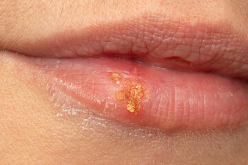 Macro of woman's lips with cold sores