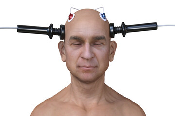 Fototapeta na wymiar Electroconvulsive therapy, ECT, a treatment involving the use of electrical currents to stimulate the brain, 3D illustration