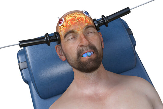 Electroconvulsive therapy, ECT, a treatment involving the use of electrical currents to stimulate the brain, 3D illustration