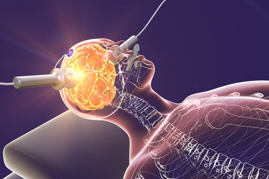 Electroconvulsive therapy, ECT, a treatment involving the use of electrical currents to stimulate the brain, 3D illustration