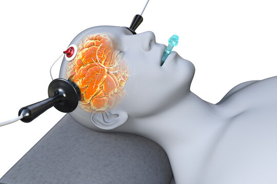 Electroconvulsive therapy, ECT, a treatment involving the use of electrical currents to stimulate the brain, 3D illustration
