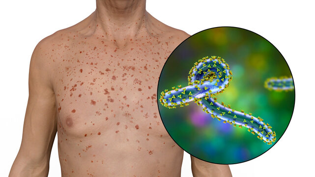A skin rash on the chest of a patient with Marburg hemorrhagic fever and close-up view of the virus, 3D illustration