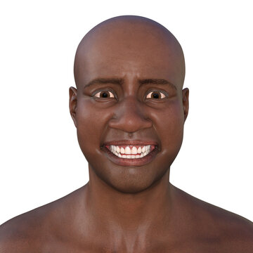 A 3D illustration depicting a person suffering from tetanus, shown with lockjaw symptom, also known as trismus