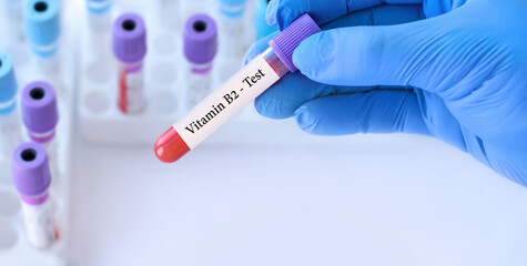 Obraz premium Doctor holding a test blood sample tube with Vitamin B2 test on the background of medical test tubes with analyzes.