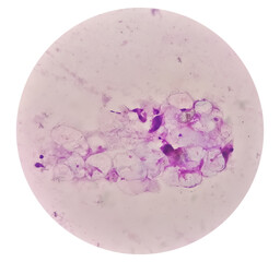 Microscopic analysis showing Epidermal inclusion cyst, swelling of left thigh