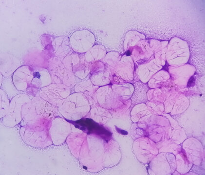 Microscopic analysis showing Epidermal inclusion cyst, swelling of left thigh