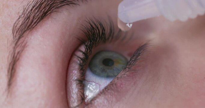 Woman dropping medical eye drops into the eye. Eye drops
