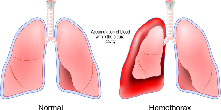 Hemothorax. Healthy human lungs and red lungs after accumulation of blood within the pleural cavity