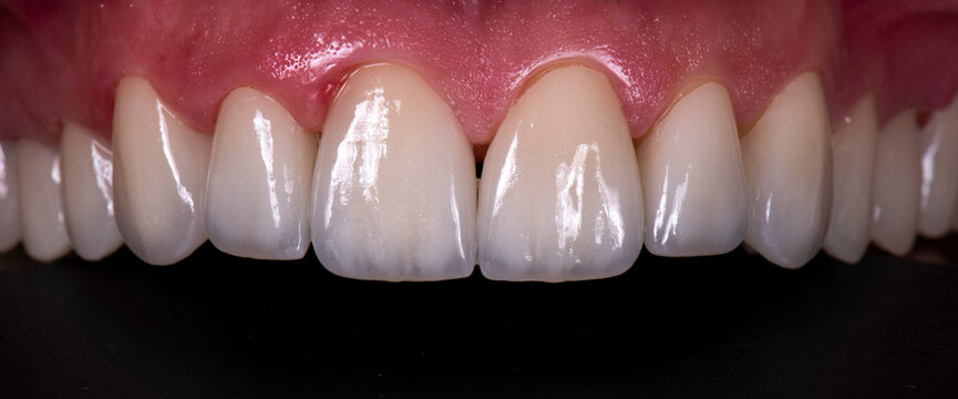 Emax ceramic crowns and veneers like natural teeth