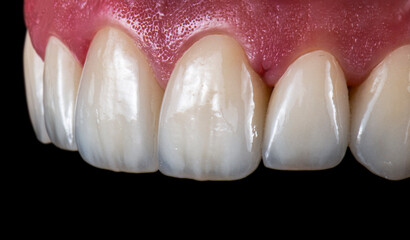 Emax ceramic crowns and veneers like natural teeth