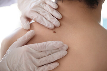 Dermatologist examining mole on young man's back in clinic, closeup
