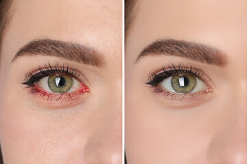 Collage with photos of woman before and after conjunctivitis treatment, closeup of infected and...