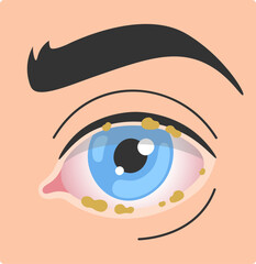 Blepharitis Human Eye Disease