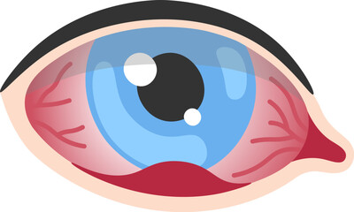 Fototapeta premium Stye Human Eye Disease