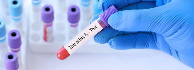 Naklejka premium The doctor holds a test blood sample tube with hepatitis B virus (HBV) test on the background of medical test tubes