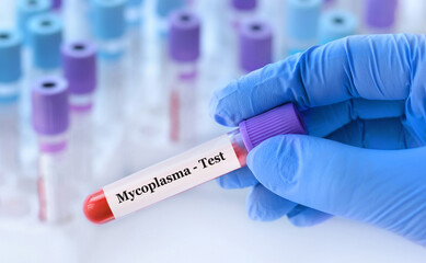 Doctor holding a test blood sample tube with Mycoplasma test on the background of medical test tubes with analyzes.