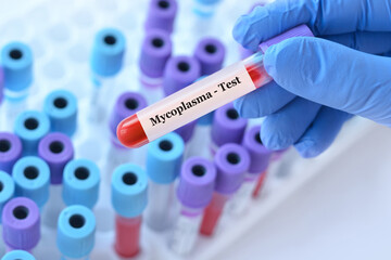 Naklejka premium Doctor holding a test blood sample tube with Mycoplasma test on the background of medical test tubes with analyzes.