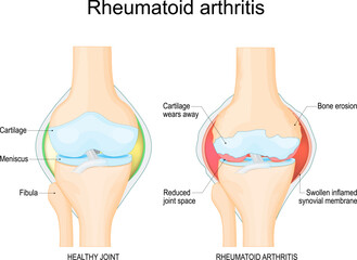 Rheumatoid arthritis of a knee joint - obrazy, fototapety, plakaty
