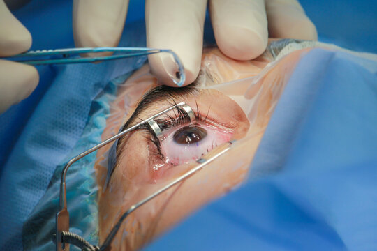 ophthalmology eye surgery excimer laser