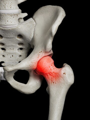 3d medical illustration of the human hip joint - hip pain