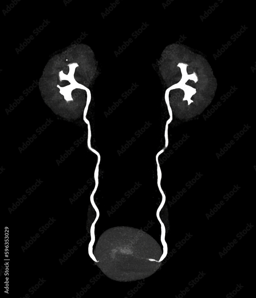 Poster cta renal artery 3d rendering image showing both kidney, ureter and bladder .