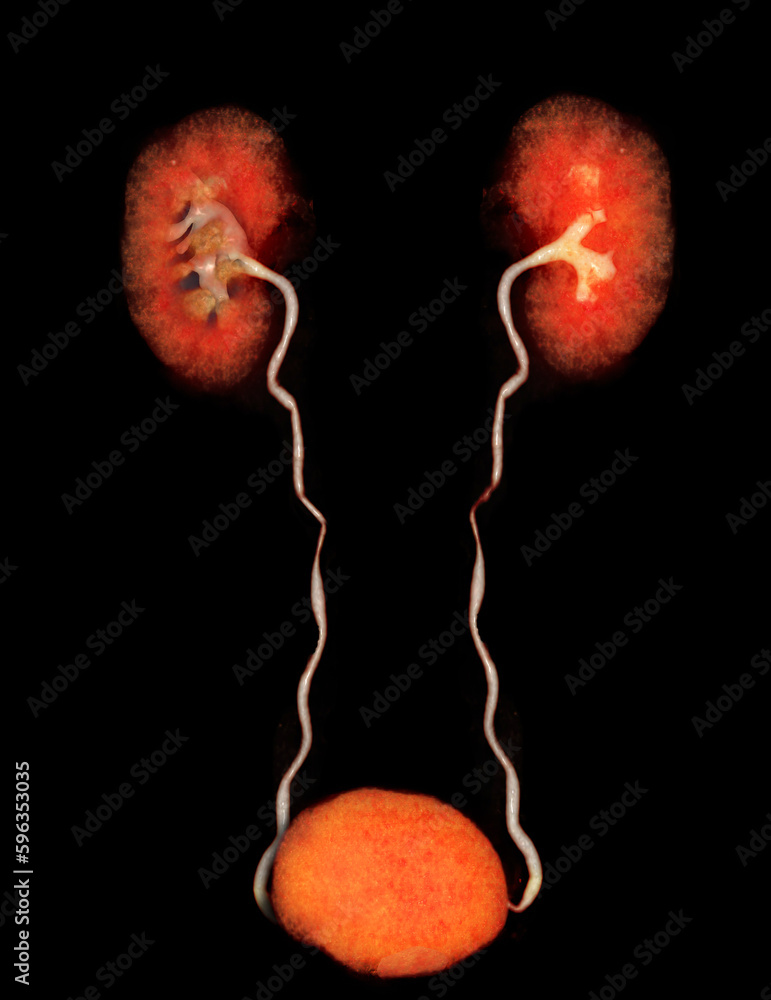 Poster cta renal artery 3d rendering image showing both kidney, ureter and bladder .