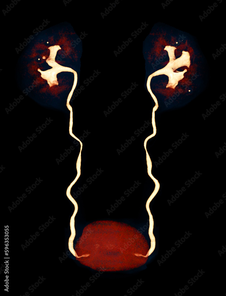 Poster cta renal artery 3d rendering image showing both kidney, ureter and bladder .