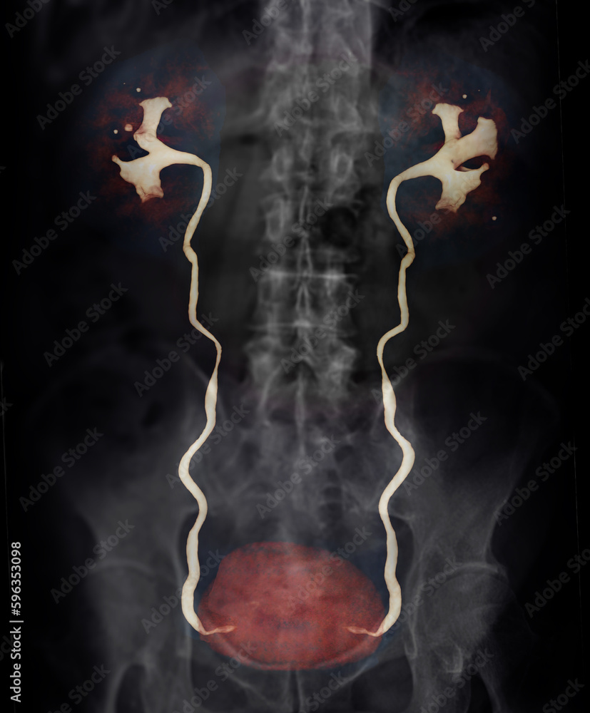 Poster cta renal artery 3d rendering image showing both kidney, ureter and bladder .