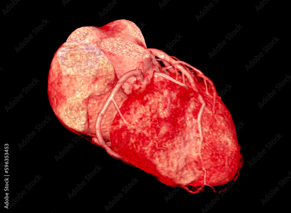 Poster cta coronary artery 3d rendering image.